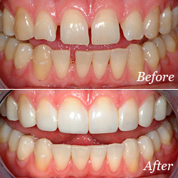 Dental Bonding Before/After
