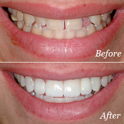 Dental Bridge Before/After