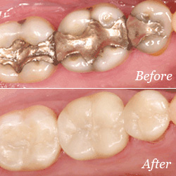 Dental Crowns before/after